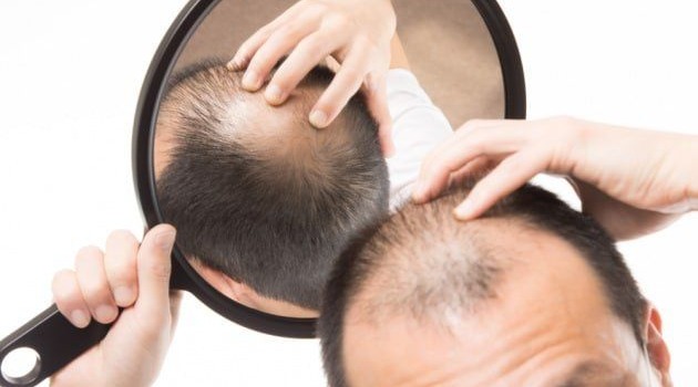 Alopecia androgenetica: di che cosa si tratta esattamente e quali sono le cause?